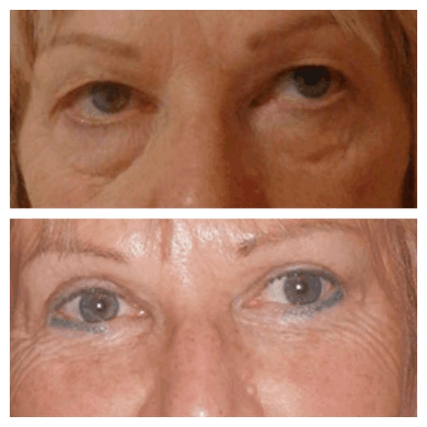 Eye Bag Removal