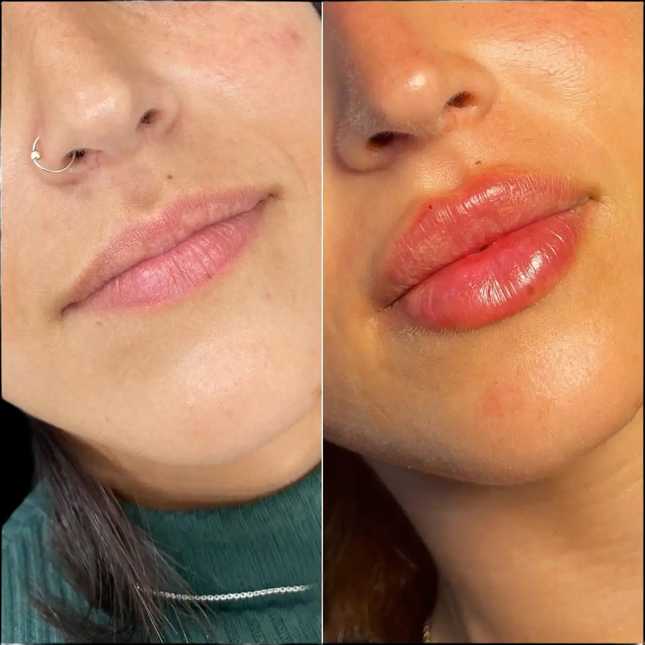 Juvederm Fillers