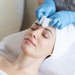 chemical peel treatment in florida