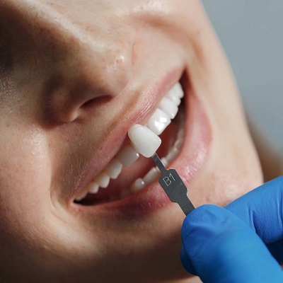 Why Choose E-Max Veneers? Key Benefits Explained