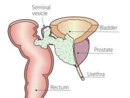 Metastatic Prostate